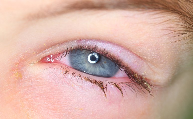 Blepharitis: Was tun bei einer Lidrandentzndung? | Brille24 DE