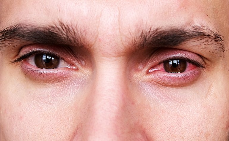 Was Tun Bei Verblitzten Augen